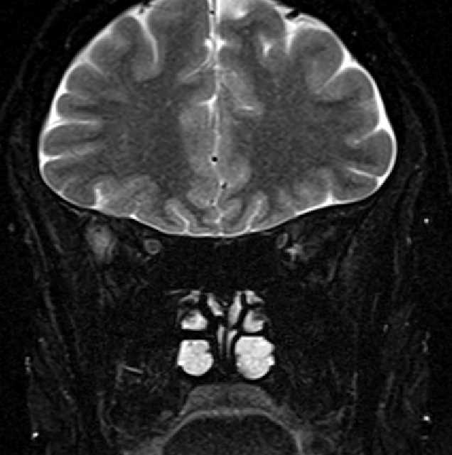 Orbital cavernous hemangioma | Image | Radiopaedia.org