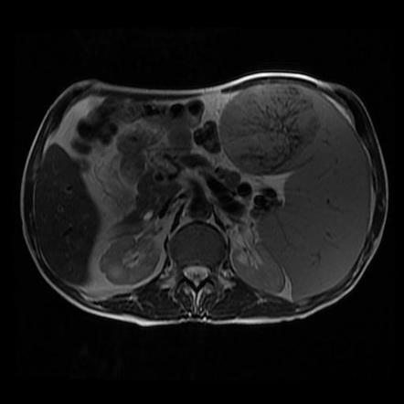 Extramedullary hematopoiesis - spleen | Image | Radiopaedia.org