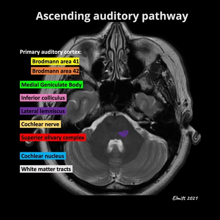 5th of facial nerve mri