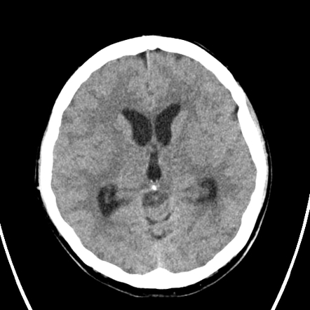 Bacterial Meningitis Brain Mri