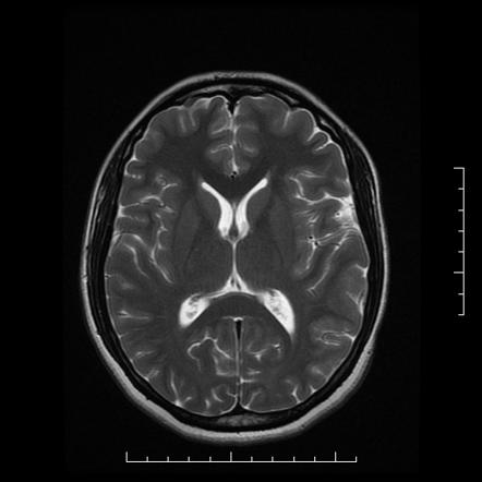 Cerebellar tuberculoma | Image | Radiopaedia.org