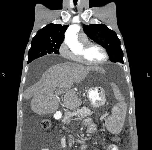 Cirrhosis | Image | Radiopaedia.org