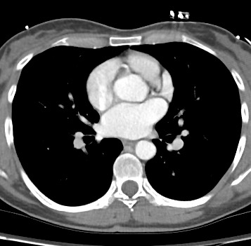 Pulmonary and CNS cryptococcosis | Image | Radiopaedia.org