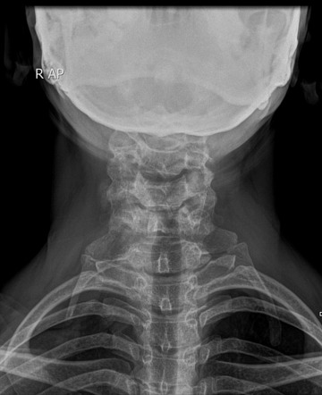 Cervical rib | Radiology Reference Article | Radiopaedia.org