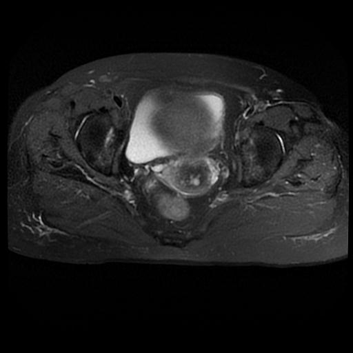 Endometrial Carcinoma Figo Stage 1a Image 