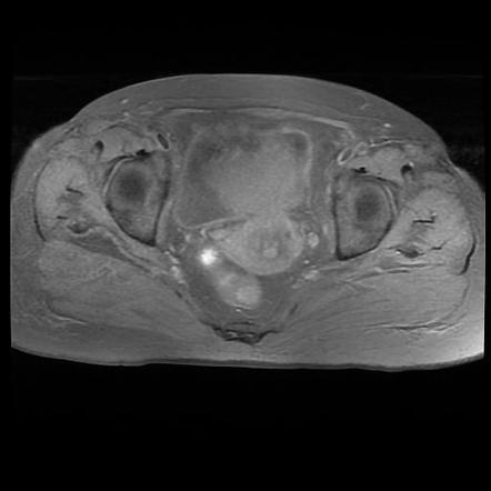 Endometrial carcinoma - FIGO stage 1a | Image | Radiopaedia.org