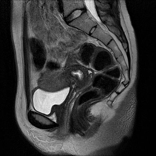 Uterine Adenomyosis Noninvasive Diagnosis Mdedge Obgyn