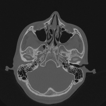 Keratosis obturans | Radiology Case | Radiopaedia.org