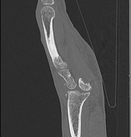 Trans-scaphoid perilunate dislocation | Image | Radiopaedia.org