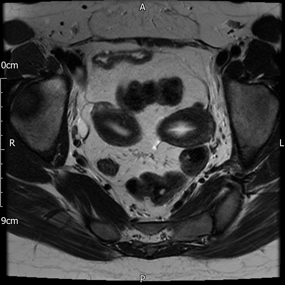 Real Uterus Didelphys Images