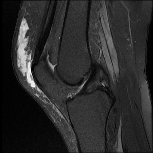 Prepatellar bursitis | Image | Radiopaedia.org