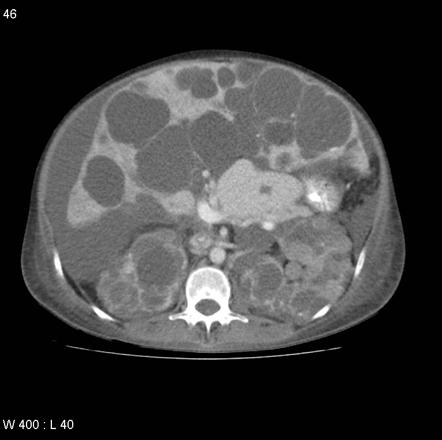 Autosomal dominant polycystic kidney disease with extensive hepatic ...