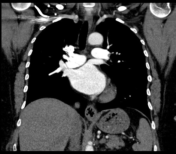 Normal spectral CTPA | Image | Radiopaedia.org