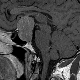 Pituitary Macroadenoma | Image | Radiopaedia.org