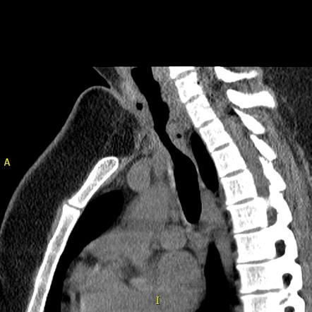 Steeple sign (trachea), Radiology Reference Article