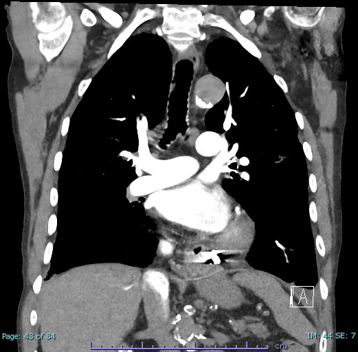 Malpositioned Angelchik Antireflux Prosthesis | Image | Radiopaedia.org