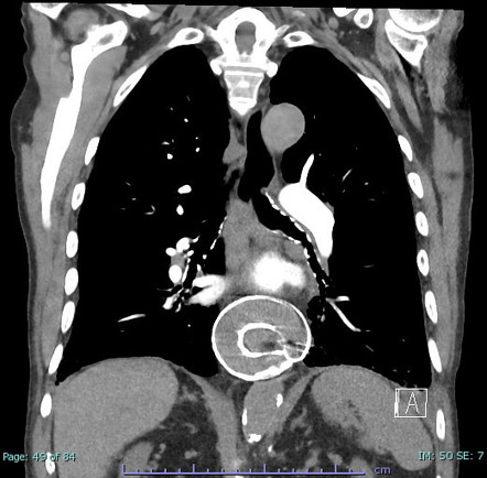 Malpositioned Angelchik Antireflux Prosthesis | Radiology Case ...