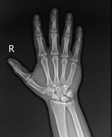 Fifth metacarpal base fracture Radiology Case Radiopaedia