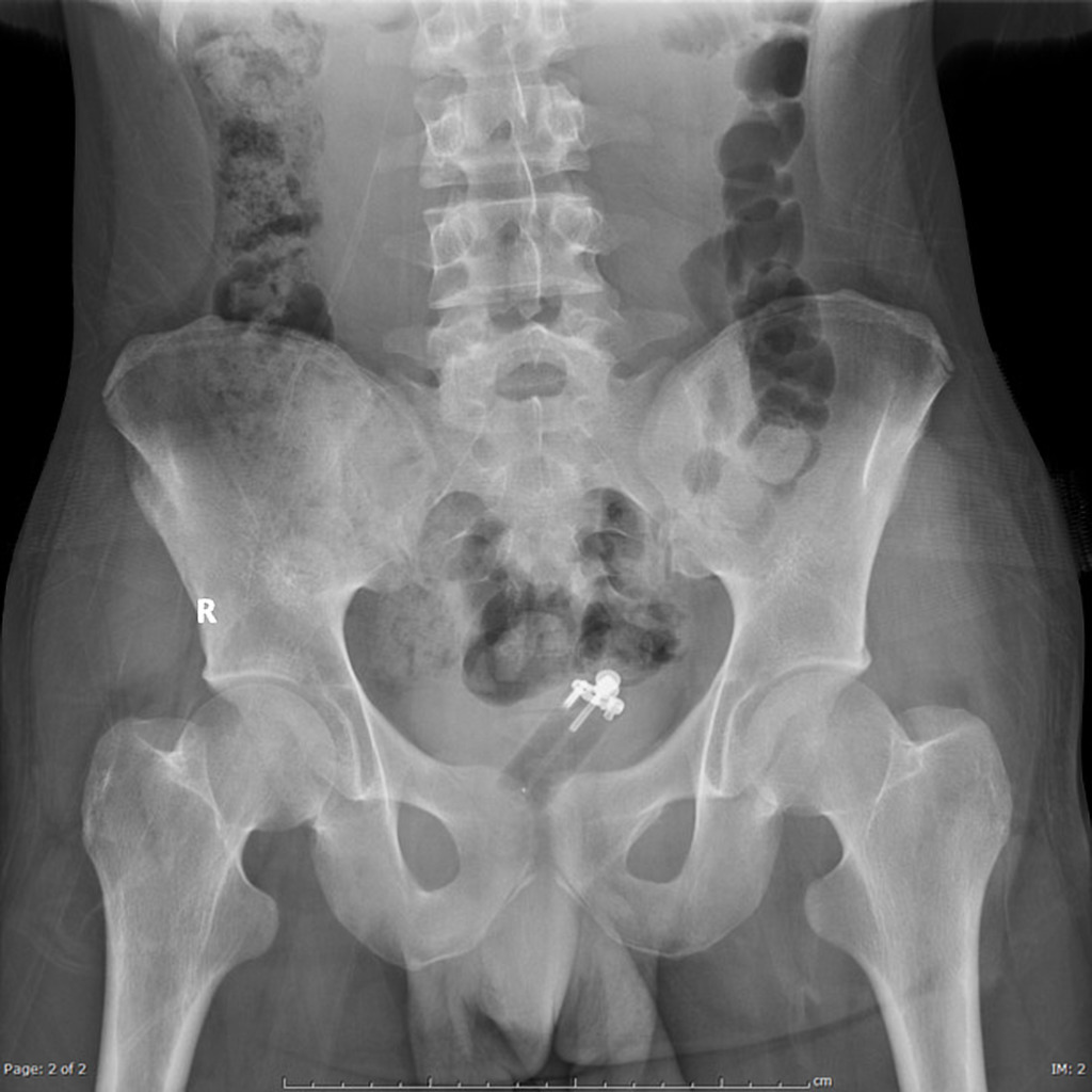 30-nonobstructive-bowel-gas-pattern-lovesohael