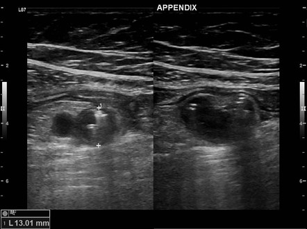 Appendicitis | Image | Radiopaedia.org