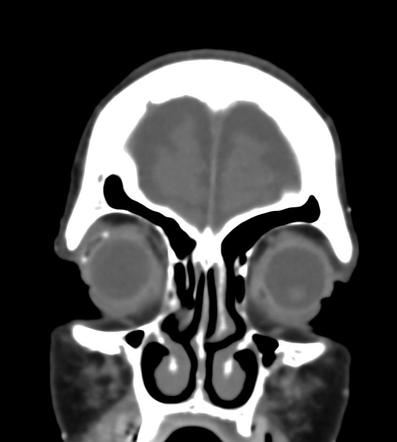 Glaucoma drainage implant | Radiology Case | Radiopaedia.org