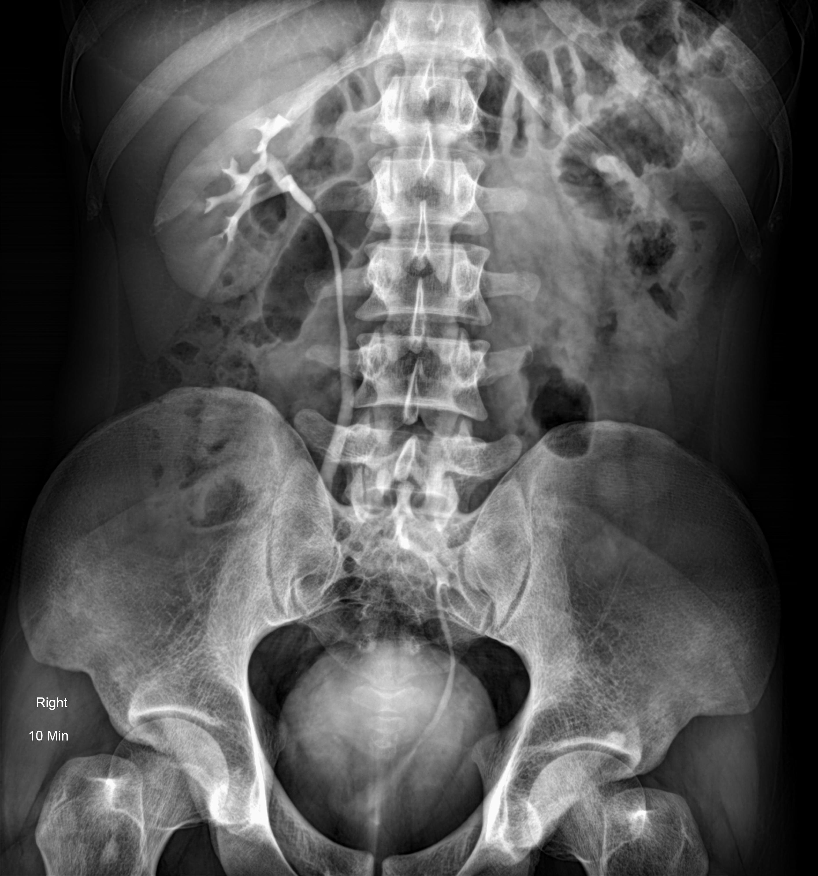 Left ectopic kidney | Image | Radiopaedia.org