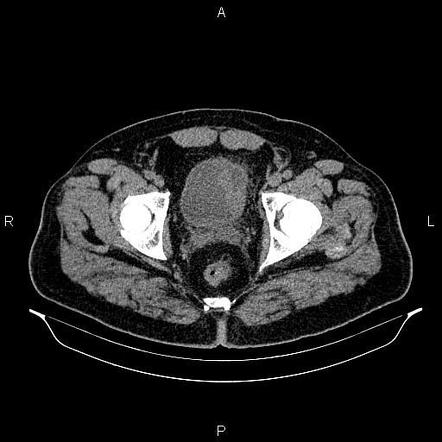 Metastatic Urinary Bladder Cancer | Image | Radiopaedia.org