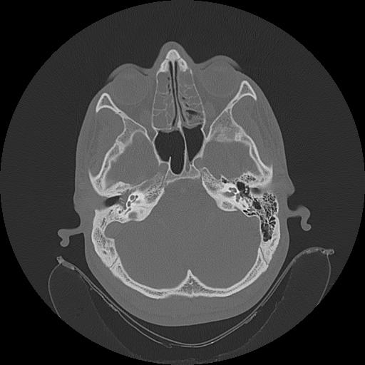 Adenoid stones within hypertrophied adenoid tonsils | Image ...