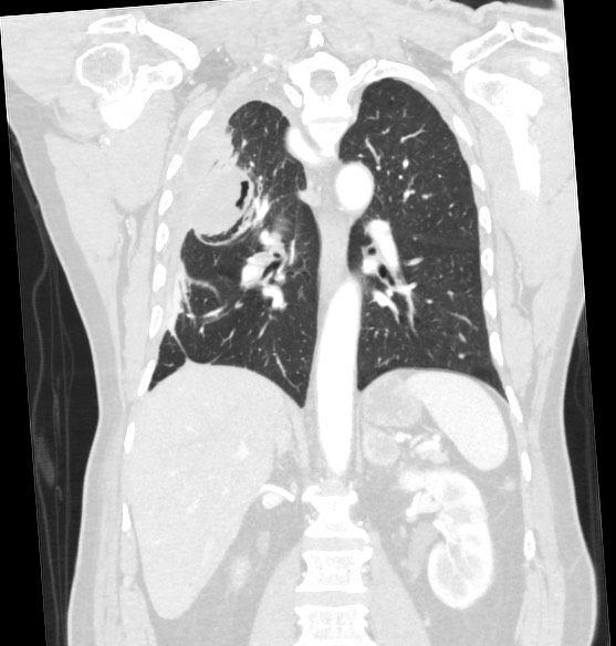 Metastatic Lung Cancer Image 8743