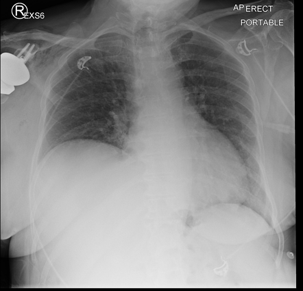 Phrenic nerve palsy | Radiology Case | Radiopaedia.org