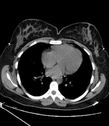 Tuberculous sternocostal arthritis | Image | Radiopaedia.org