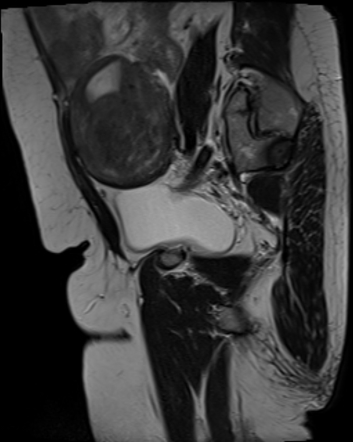 Uterine leiomyoma | Radiology Case | Radiopaedia.org