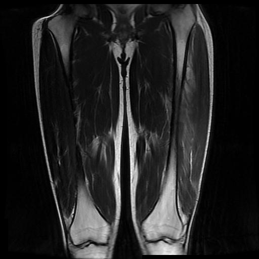 Intramuscular hematoma - thigh | Image | Radiopaedia.org