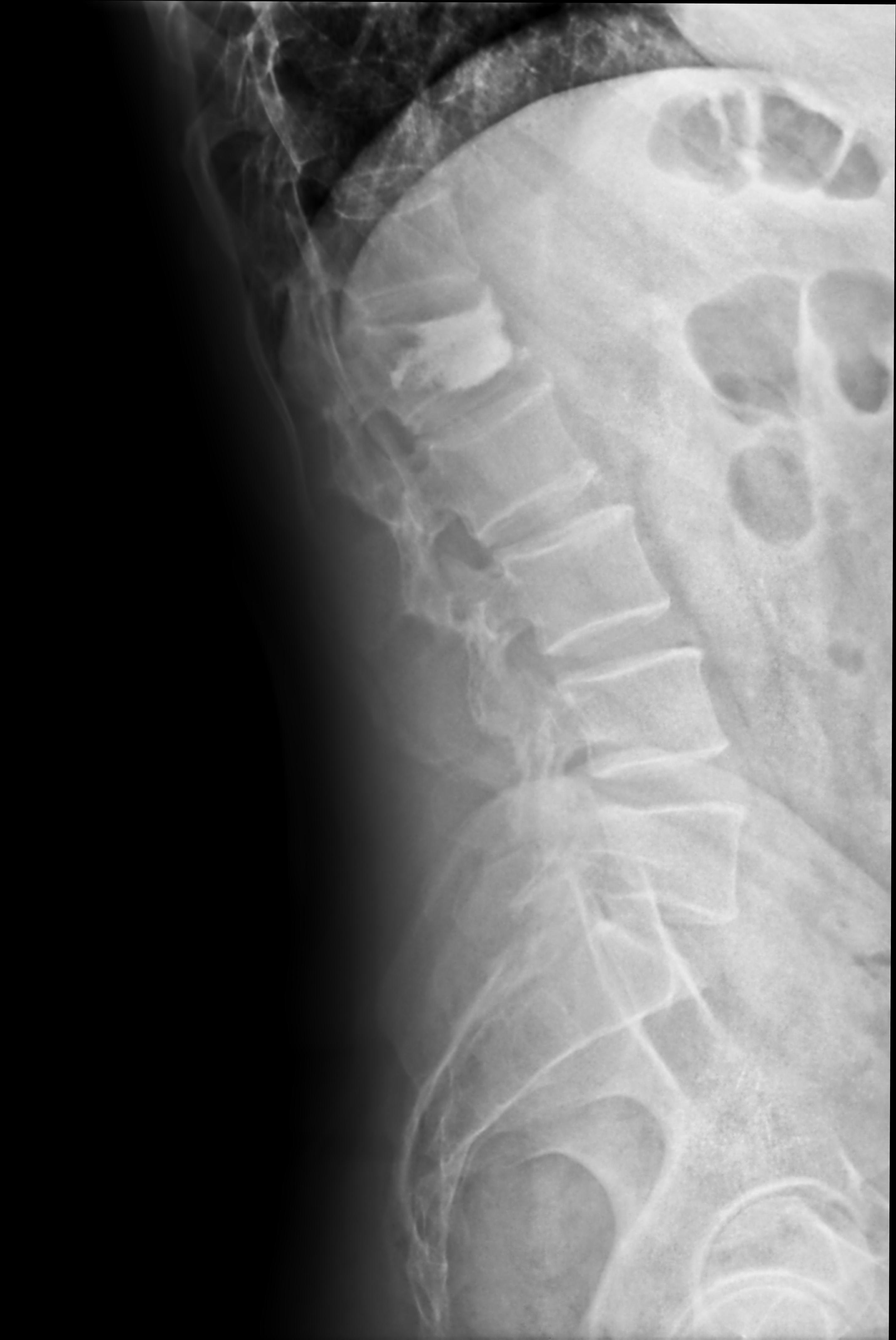 Vertebroplasty | Image | Radiopaedia.org