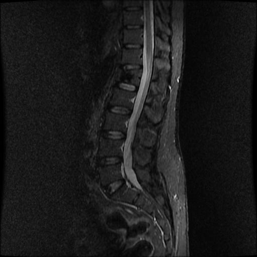 Vertebroplasty | Image | Radiopaedia.org