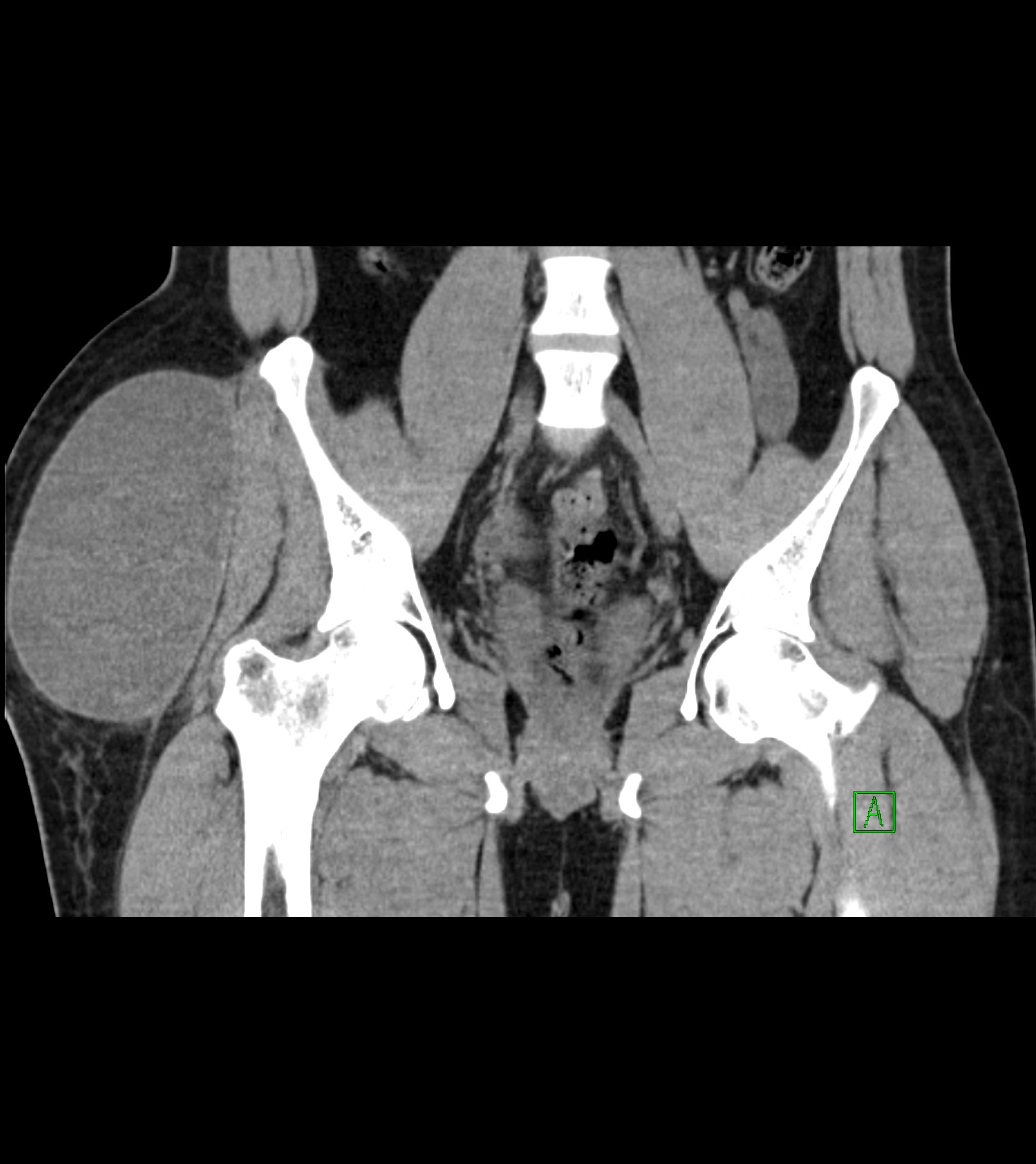 MorelLavallée lesion Image