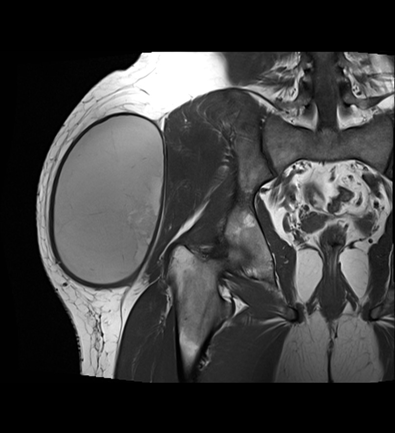 Morel Lavallée Lesion Image