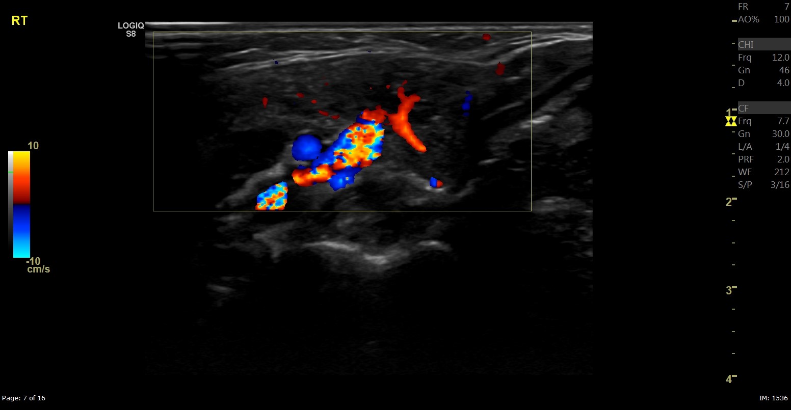 Cervical ectopic thymus | Image | Radiopaedia.org