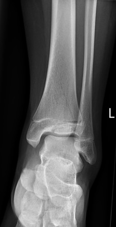 Triplane fracture - Salter Harris type IV | Radiology Case ...