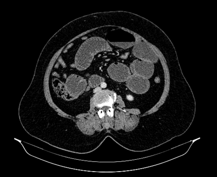 Umbilical Hernia CT Scan