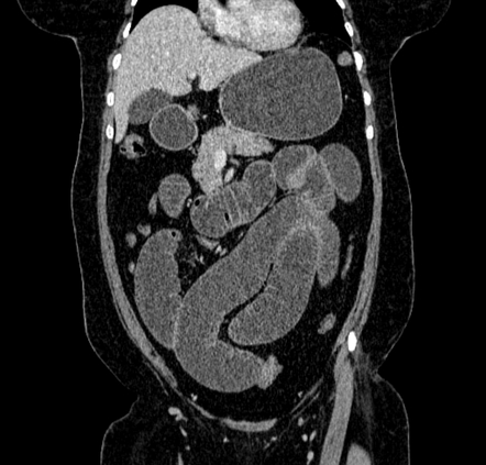 Umbilical Hernia CT Scan