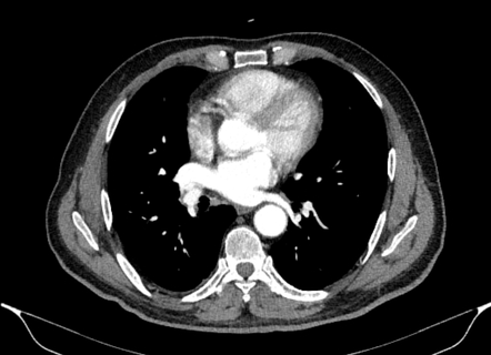 Round atelectasis | Radiology Case | Radiopaedia.org