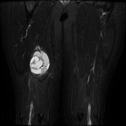 Synovial sarcoma - biphasic subtype | Image | Radiopaedia.org