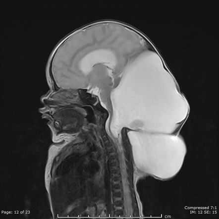 Dandy-Walker Malformation | Radiology Reference Article | Radiopaedia.org