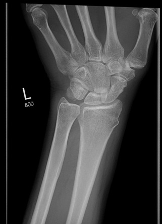 Distal radius buckle fracture - adult | Radiology Case | Radiopaedia.org