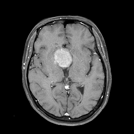 Pituitary macroadenoma with intratumoral hemorrhage | Image ...