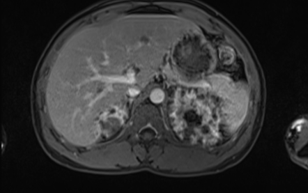 Autosomal Dominant Polycystic Kidney Disease | Image | Radiopaedia.org