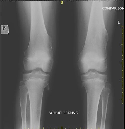 Hereditary multiple exostoses | Radiology Reference Article ...