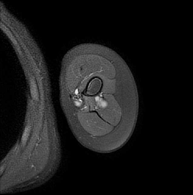 Stump neuromas - upper limb | Image | Radiopaedia.org