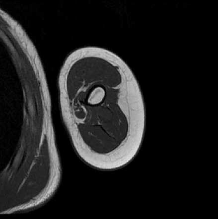 Stump neuromas - upper limb | Image | Radiopaedia.org